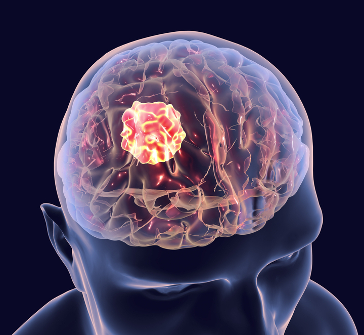 Sintomi dei tumori cerebrali. A quali altre patologie si associano?